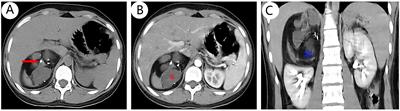 Rare Primary Adrenal Tumor: A Case Report of Teratomas and Literatures Review